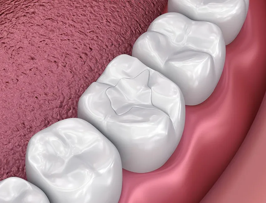 Dental Fillings in Garden Grove, CA