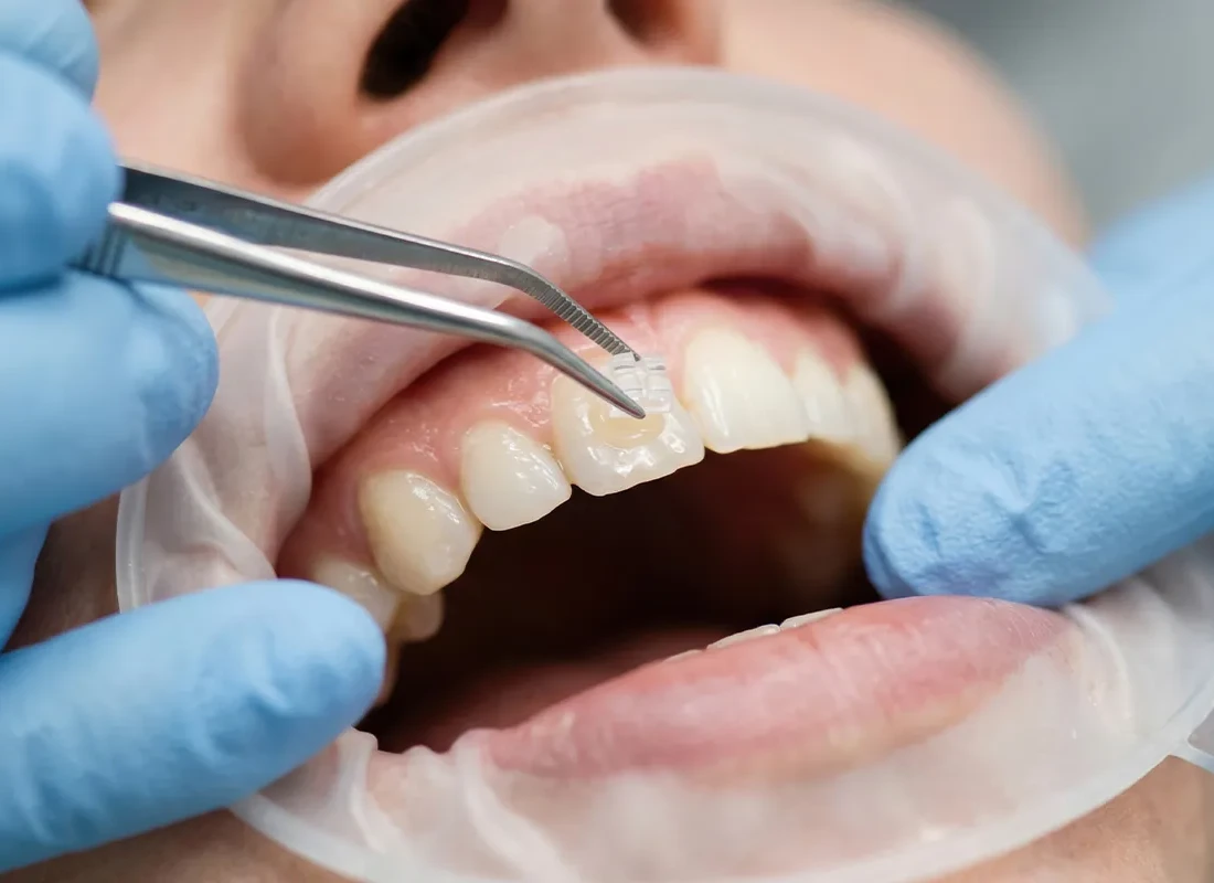 What is Bioclear Matrix System