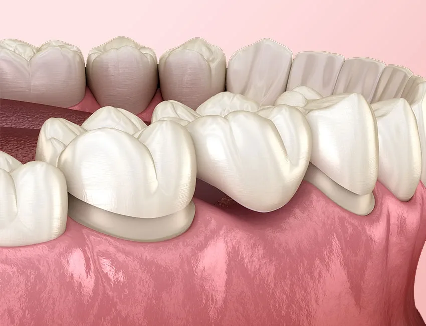 Dental Bridge in Garden Grove, CA