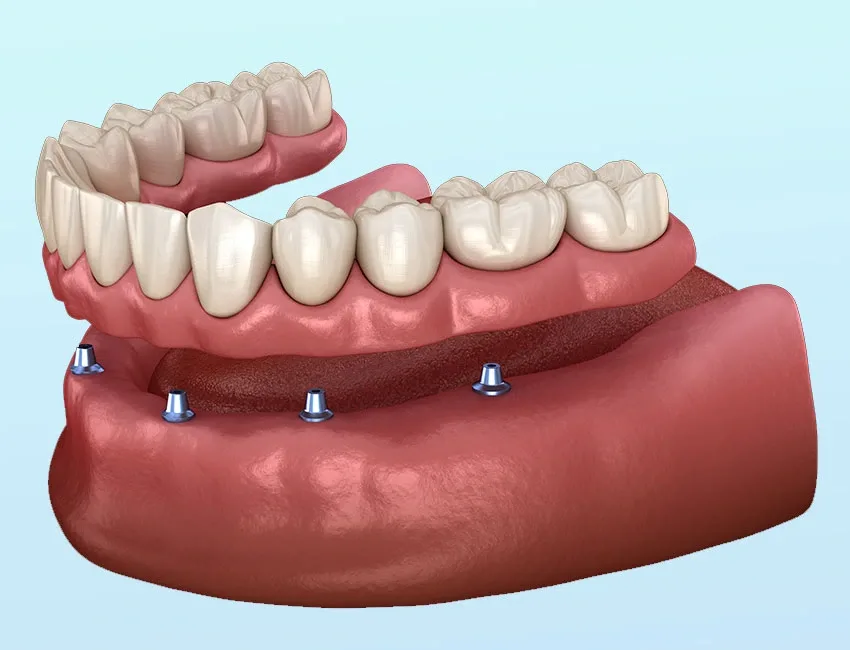 All-on-4 Dental Implants in Garden Grove, CA