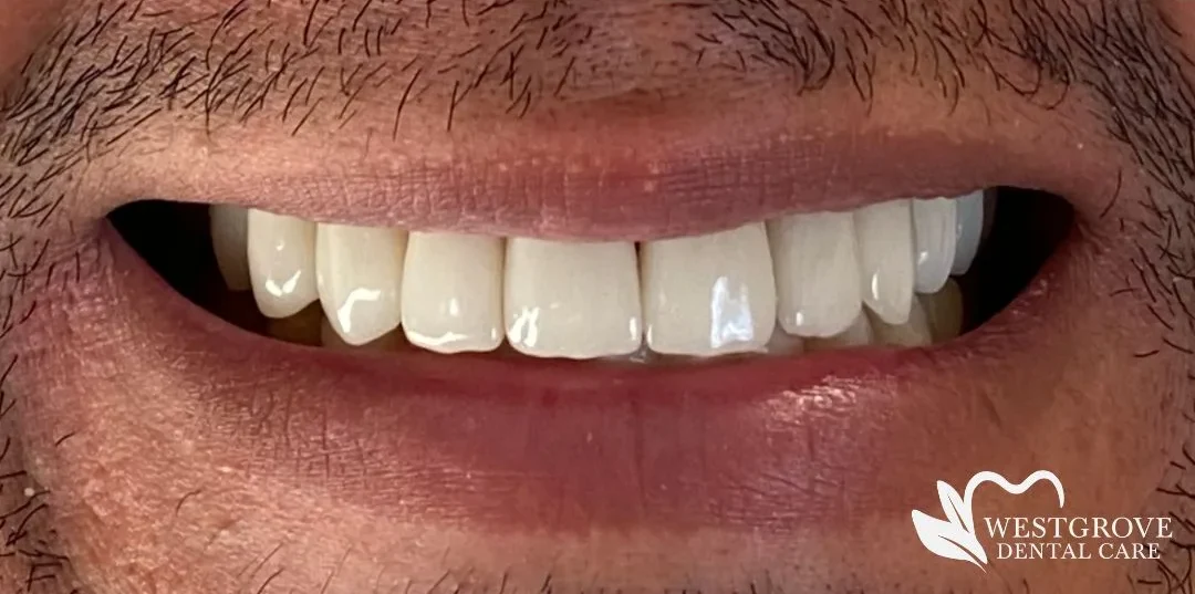 After: Dental Veneers
