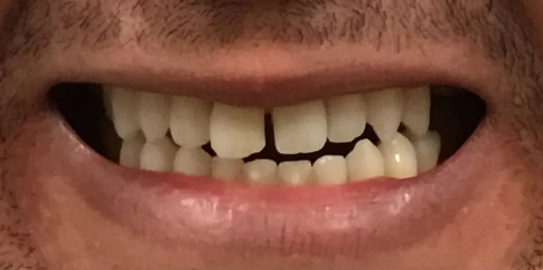 Before: Dental Veneers