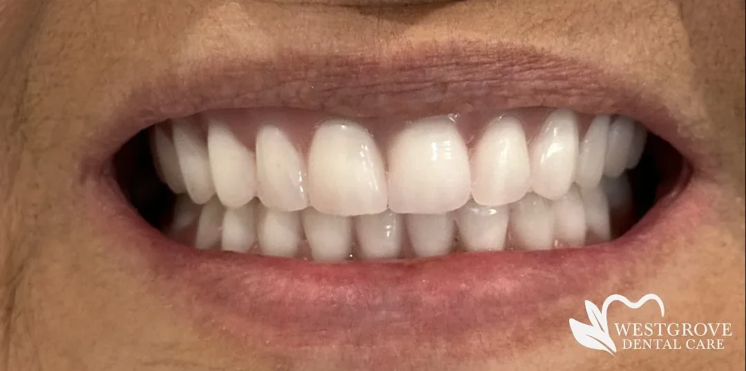 After: Full Mouth Extraction & Implant Denture