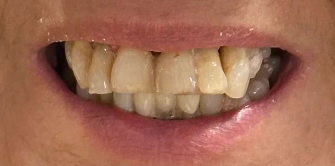 Before: Full Mouth Extraction & Implant Denture