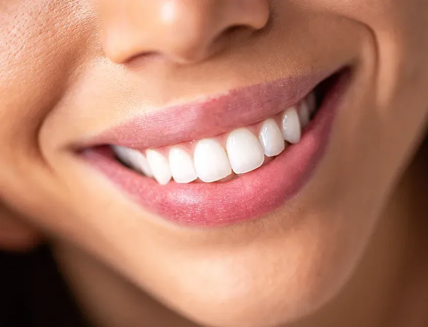 Cosmetic Bonding in Garden Grove, CA