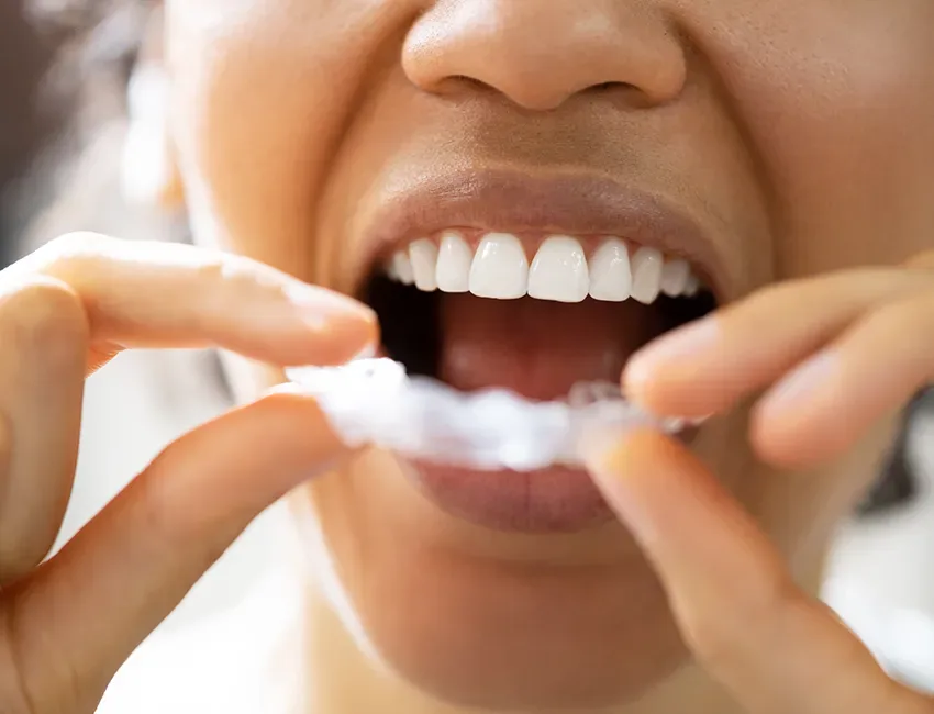 What is TMJ and Bruxism Treatment