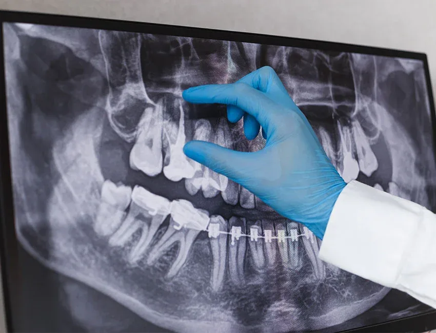 Root Canal Treatment in Garden Grove, CA