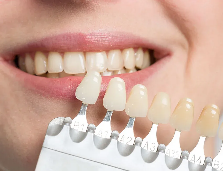 Professional Teeth Whitening in Garden Grove, CA